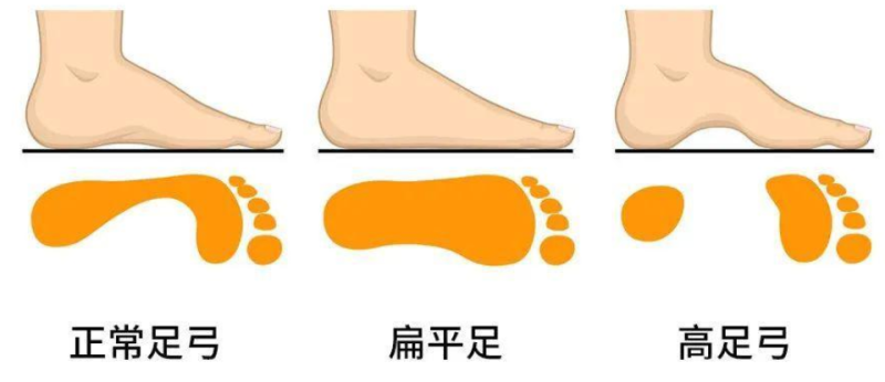 别让扁平足伤及孩子的脚，尽早定制矫正鞋干预