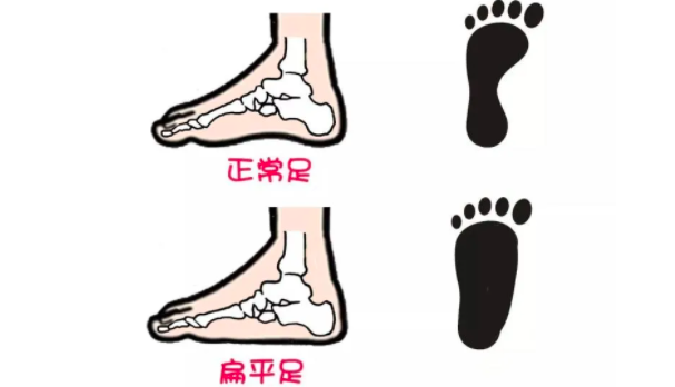 成人扁平足程度严重，需配矫正鞋垫进行干预